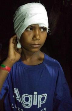 The minor boy Akash was attacked by the leopard on his head. (Sakib Ali/HT Photo) The minor boy Akash was attacked by the leopard on his head. (Sakib Ali/HT Photo)