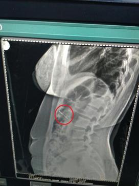 An X-ray suggested that the pin was in her stomach. (HT Photo) An X-ray suggested that the pin was in her stomach. (HT Photo)