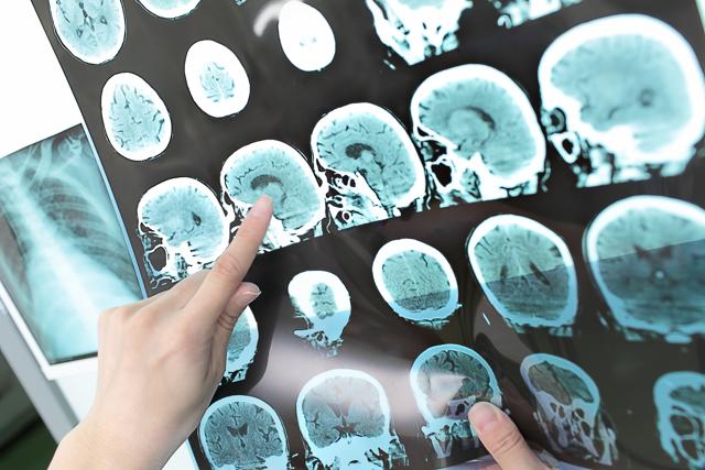 Typically, people are diagnosed with multiple sclerosis in their 20s and 30s, and it is more common in women than men. (Shutterstock) Typically, people are diagnosed with multiple sclerosis in their 20s and 30s, and it is more common in women than men. (Shutterstock)