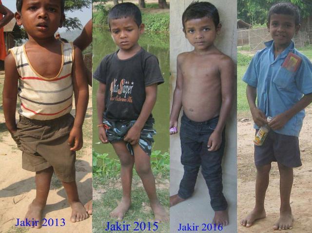 Jakir, who was affected by fluorosis, was photographed over four years. It takes years of administration of medicines before some of the effects of fluorosis are reversed. (Dharani Saikia) Jakir, who was affected by fluorosis, was photographed over four years. It takes years of administration of medicines before some of the effects of fluorosis are reversed. (Dharani Saikia)