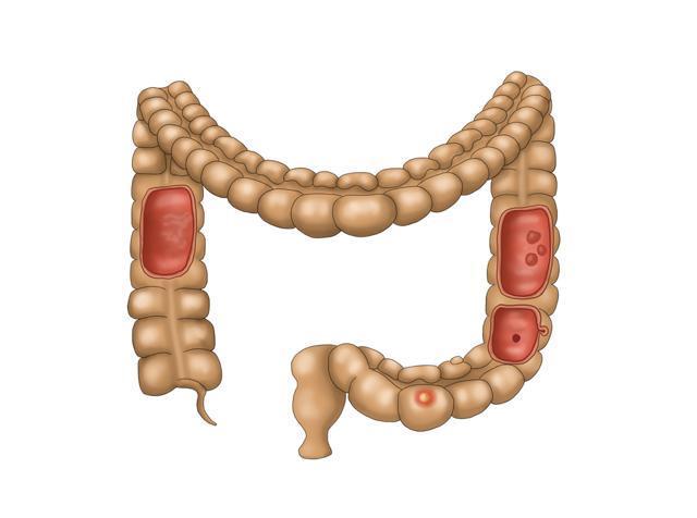 The study said overweight boys who remained overweight as young men had twice the colon cancer risk. (Shutterstock) The study said overweight boys who remained overweight as young men had twice the colon cancer risk. (Shutterstock)