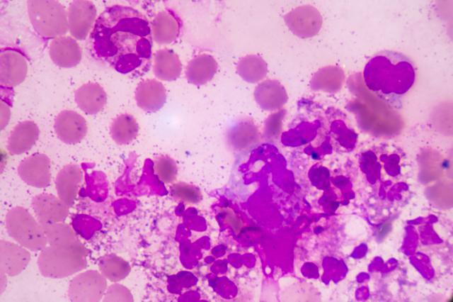 Sepsis or septicaemia is a life-threatening illness. Presence of numerous bacteria in the blood, causes the body to respond in organ dysfunction. (Shutterstock)