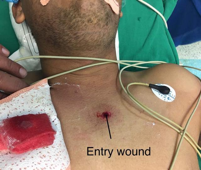 The 3-mm entry wound in Verma’s chest. (HT Photo) The 3-mm entry wound in Verma’s chest. (HT Photo)