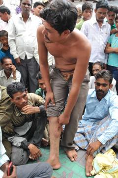 One of the men show the bruises on his leg. (Mujeeb Faruqui/HT) One of the men show the bruises on his leg. (Mujeeb Faruqui/HT)