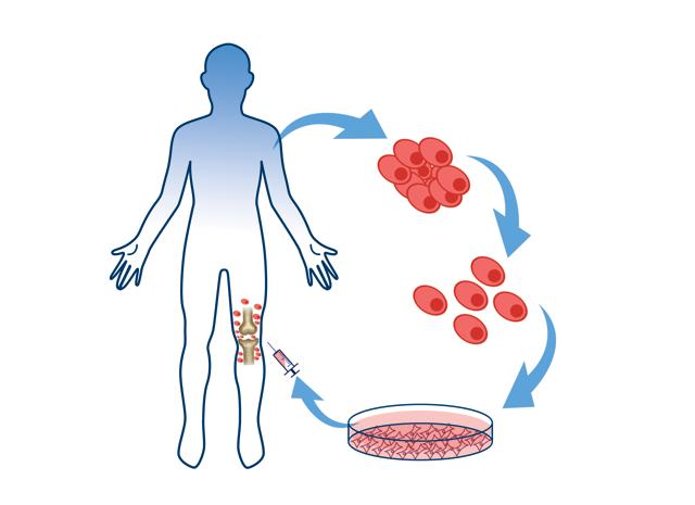 Instead of using artificial implants, the technique helps in healing the bone or cartilage damage in a natural way using a person’s own cells to regain normal function. Cultured cells (grown in a lab) are injected into a patient to replace diseased or dysfunctional cells. (Illustration: Siddhant Jumde) Instead of using artificial implants, the technique helps in healing the bone or cartilage damage in a natural way using a person’s own cells to regain normal function. Cultured cells (grown in a lab) are injected into a patient to replace diseased or dysfunctional cells. (Illustration: Siddhant Jumde)