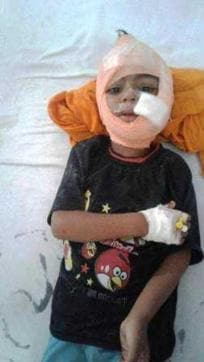 A four-year-old victim undergoing treatment at Rajindra Hospital. (HT Photo) A four-year-old victim undergoing treatment at Rajindra Hospital. (HT Photo)