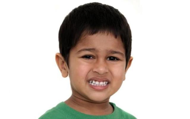 Over time, sleep bruxism can lead to major oral health problems, including migraines, sensitive and worn teeth, chipped or cracked teeth, loosening of teeth and severe oral pain. (Shutterstock)