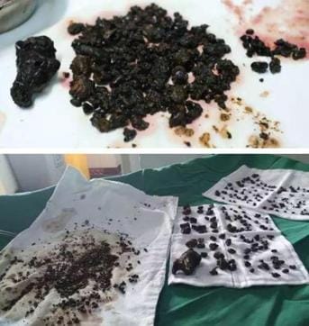 Some of the gallstones were almost as big as eggs. (Photo courtesy: Hezhou Guangji Hospital)