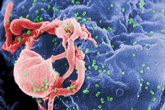 This undated photo provided by the Centers for Disease Control and Prevention shows a scanning electron micrograph of multiple round bumps of the HIV-1 virus on a cell surface. (AP Photo) This undated photo provided by the Centers for Disease Control and Prevention shows a scanning electron micrograph of multiple round bumps of the HIV-1 virus on a cell surface. (AP Photo)