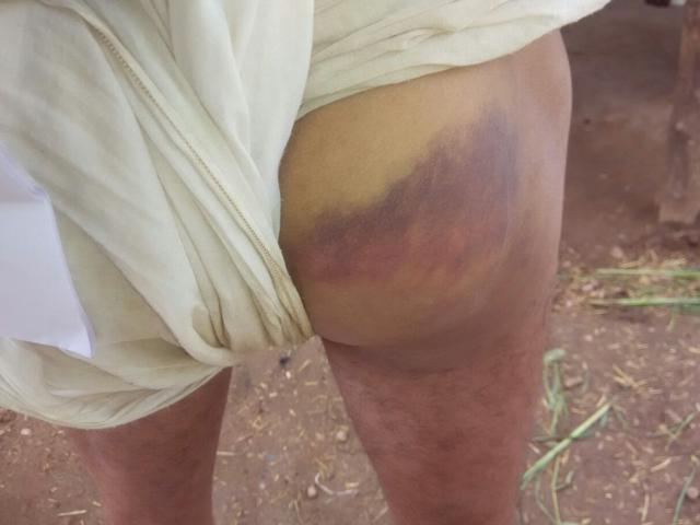 Bale Ivne has alleged that the marks on his body are due to police torture. (Mayank Bhargava/HT Photo) Bale Ivne has alleged that the marks on his body are due to police torture. (Mayank Bhargava/HT Photo)