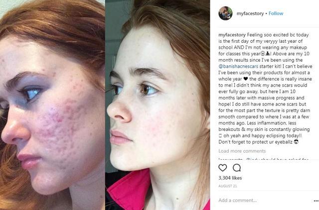 acne scars before and after accutane