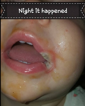 The child suffered the severe burn within a “few seconds” of putting the charger in her mouth (Facebook/Courtney N Davis)