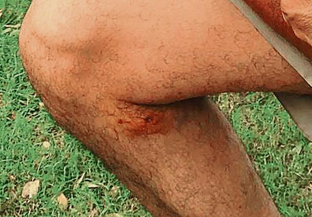 The dog bite mark on Rajiv Kumar Jatiwal’s leg. (VIKRAM JIT SINGH)