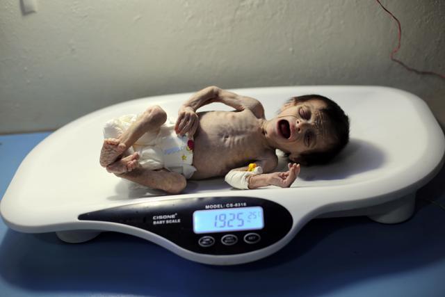 Sahar weighed less than 2 kilograms. When she tried to cry, she lacked strength to make much of a noise. (AFP) Sahar weighed less than 2 kilograms. When she tried to cry, she lacked strength to make much of a noise. (AFP)