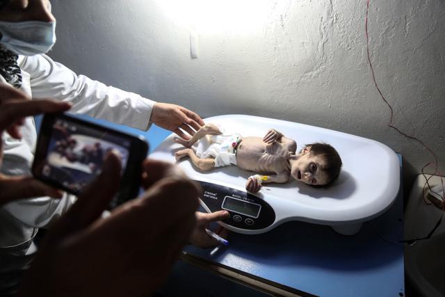 Sahar was the latest victim of Eastern Ghouta’s food crisis. Medics at hospitals and health clinics in Eastern Ghouta say they examine dozens of malnourished children a day -- and that the number is on the rise. (AFP) Sahar was the latest victim of Eastern Ghouta’s food crisis. Medics at hospitals and health clinics in Eastern Ghouta say they examine dozens of malnourished children a day -- and that the number is on the rise. (AFP)