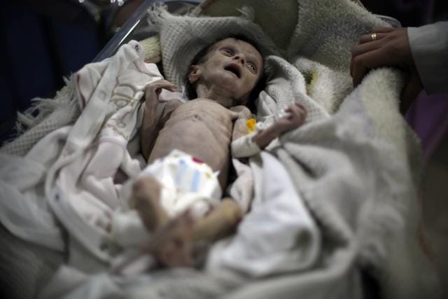 One-month-old Sahar’s mother was too undernourished to breastfeed, her father too poor to afford milk or supplements. (AFP) One-month-old Sahar’s mother was too undernourished to breastfeed, her father too poor to afford milk or supplements. (AFP)