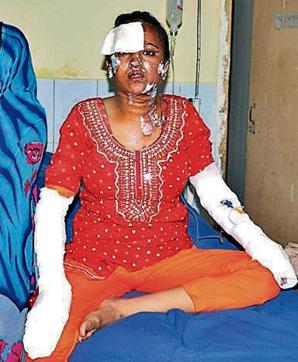 One of Shatrughan Paswan’s family members undergoing treatment in Ludhiana on Thursday. (Gurpreet Singh/HT)