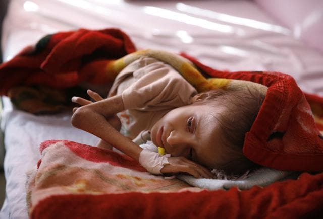 A malnourished child lies in a bed waiting to receive treatment at a therapeutic feeding center in a hospital in Sanaa, Yemen. (AP File Photo)