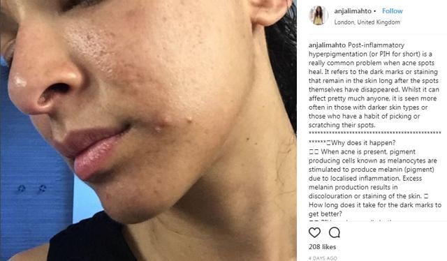 Dr Anjali Mahto, consultant dermatologist at 55 Harley Street, posted photos of her acne on Instagram to show that she is okay with the condition. (Instagram/AnjaliMahto ) Dr Anjali Mahto, consultant dermatologist at 55 Harley Street, posted photos of her acne on Instagram to show that she is okay with the condition. (Instagram/AnjaliMahto )