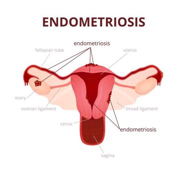 Endometriosis affects 176 million women worldwide. (Shutterstock) Endometriosis affects 176 million women worldwide. (Shutterstock)
