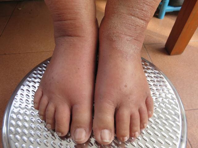 Swollen Feet: Common Causes and Symptoms
