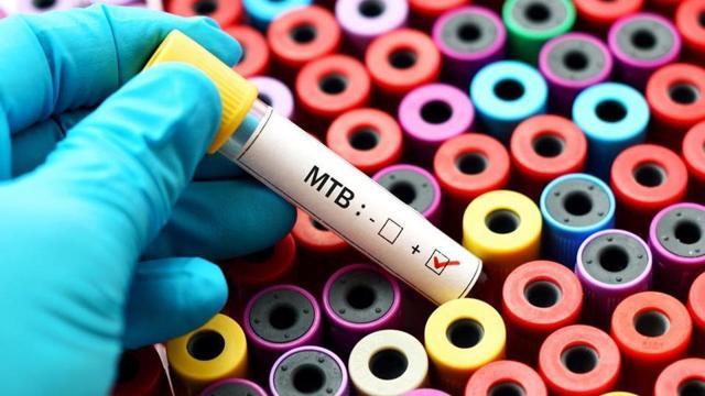 TB mimics symptoms of other diseases. (Shutterstock) TB mimics symptoms of other diseases. (Shutterstock)