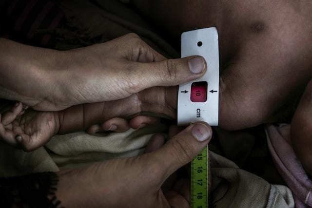 Staff measure the middle upper arm of Salima Ahmed Koryat, a 6-month-old Yemeni girl, to test how malnourished she is at the main hospital in Mocha, Yemen. (AP) Staff measure the middle upper arm of Salima Ahmed Koryat, a 6-month-old Yemeni girl, to test how malnourished she is at the main hospital in Mocha, Yemen. (AP)