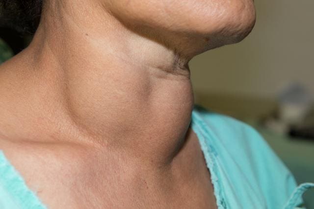 Lateral view of enlarged multinodular thyroid goiter. (Shutterstock) Lateral view of enlarged multinodular thyroid goiter. (Shutterstock)