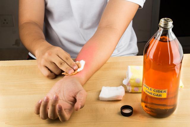Apple cider vinegar is an effective natural remedy for skin itches, fungal infections and bruises. (Shutterstock) Apple cider vinegar is an effective natural remedy for skin itches, fungal infections and bruises. (Shutterstock)