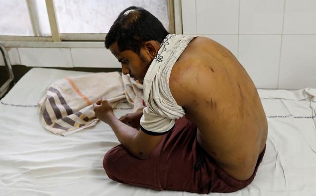 Mohammed Salman, who survived a mob lynching attack which killed his friend Mohammed Azam, displays injuries in a hospital in Hyderabad. (REUTERS File Photo) Mohammed Salman, who survived a mob lynching attack which killed his friend Mohammed Azam, displays injuries in a hospital in Hyderabad. (REUTERS File Photo)