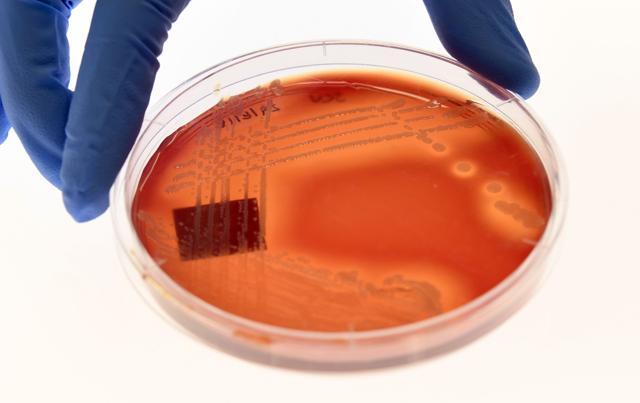 Scientists say that the superbug resistant to all known antibiotics can cause "severe" infections or even death is spreading undetected through hospital wards across the world. (AFP) Scientists say that the superbug resistant to all known antibiotics can cause "severe" infections or even death is spreading undetected through hospital wards across the world. (AFP)