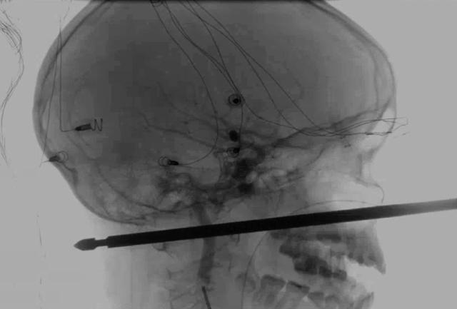 This X-ray provided by the Medical News Network shows a meat skewer impaled in the skull of Xavier Cunningham after an accident at his home Saturday, Sept. 8, 2018, in Harrisonville, Mo. (AP) This X-ray provided by the Medical News Network shows a meat skewer impaled in the skull of Xavier Cunningham after an accident at his home Saturday, Sept. 8, 2018, in Harrisonville, Mo. (AP)