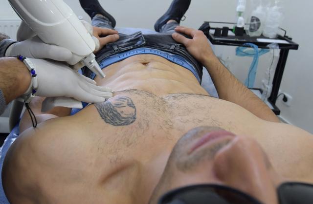 Tunisian tattoo artist Fawez Zahmoul removes a tattoo from his client in his school. (AFP) Tunisian tattoo artist Fawez Zahmoul removes a tattoo from his client in his school. (AFP)