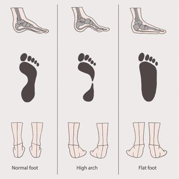 Flat feet and over-pronation can be fixed with out getting into orthotics or stability shoes (Shutterstock) Flat feet and over-pronation can be fixed with out getting into orthotics or stability shoes (Shutterstock)