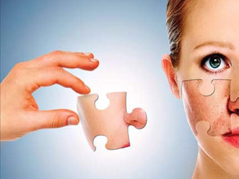 5 simple ways to keep summer acne at bay | Health - Hindustan Times