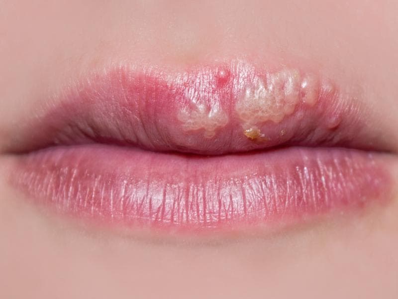 Frequent Cold Sores Around The Mouth You Probably Have Herpes Health