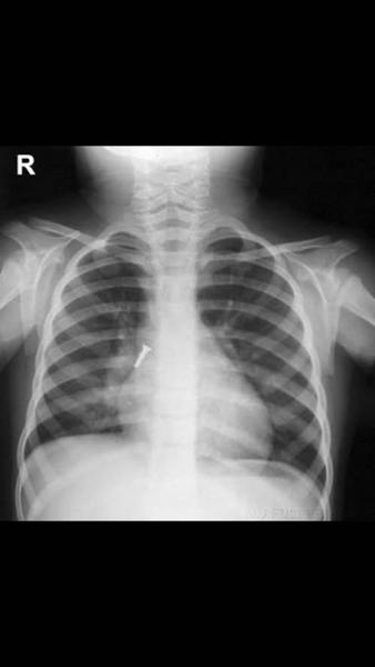 4-year-old girl who swallowed screw saved by timely surgery | Mumbai ...