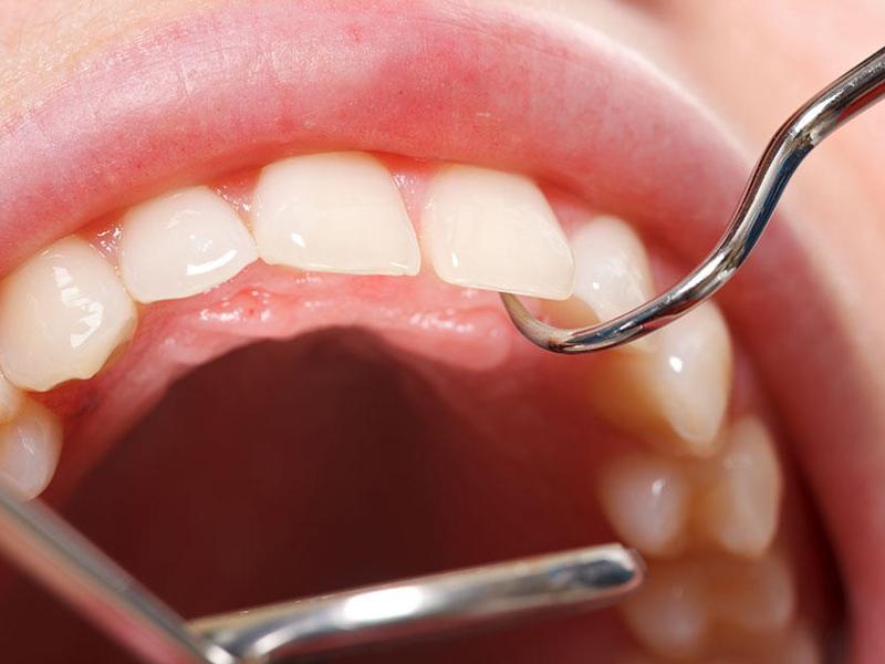 The researchers examined the data to establish how many of the patients with and without periodontal disease go on to develop cardiovascular disease (Shutterstock) The researchers examined the data to establish how many of the patients with and without periodontal disease go on to develop cardiovascular disease (Shutterstock)