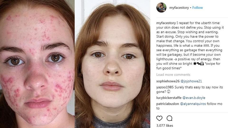 accutane before and after bacne