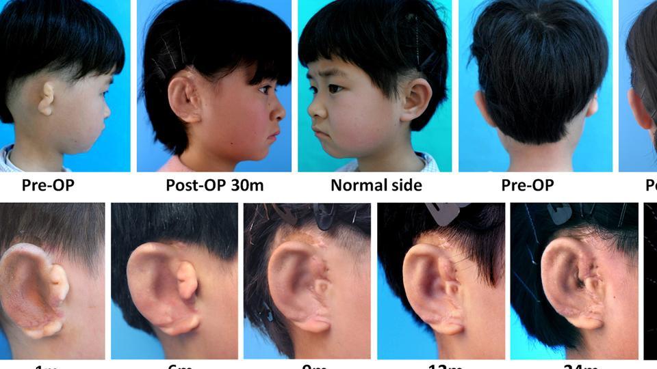 Five Chinese kids get new ears grown in lab with their own cells