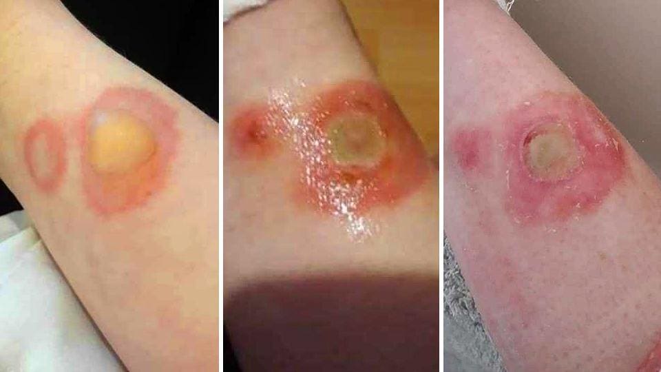 Viral 'deodorant challenge' leaves 15-year-old second-degree burns | World News - Hindustan Times