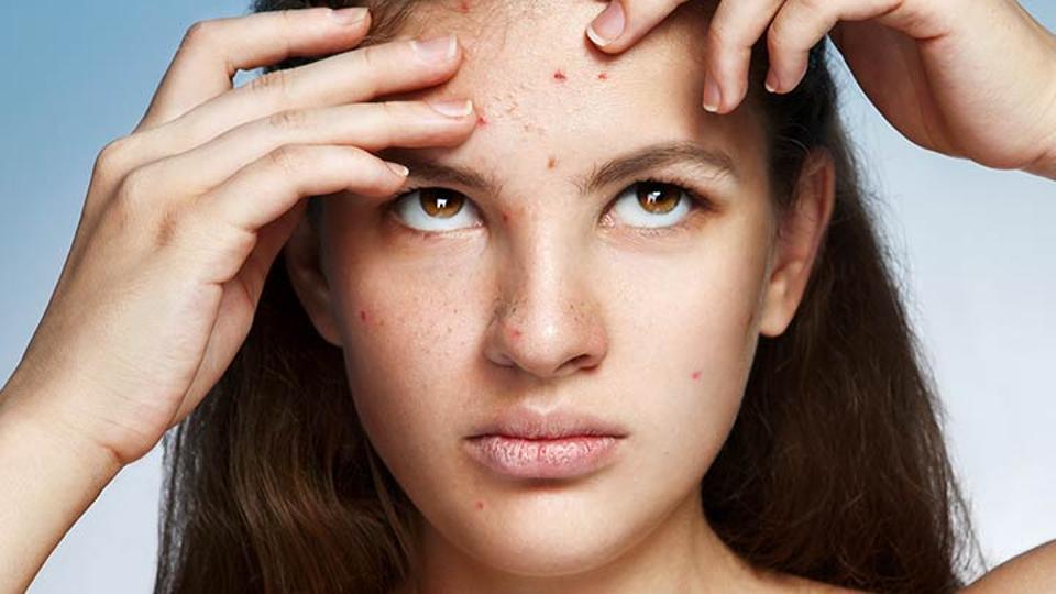 Best acne and pimple prevention tips to avoid blackheads, whiteheads