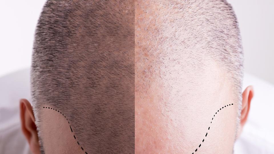 Who should get a Body Hair Transplant  Hair Sure