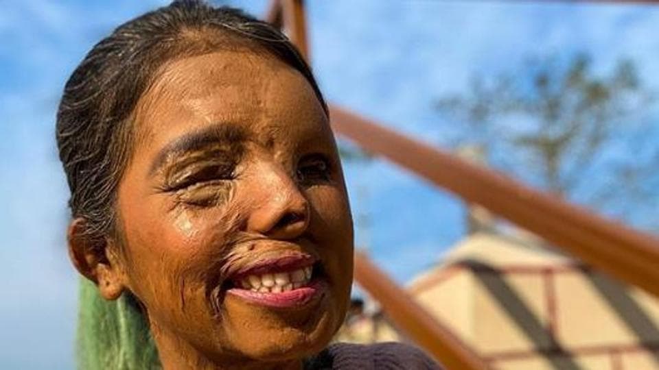 Chhapaak: As Deepika Padukone champions their cause, meet real life acid attack survivors