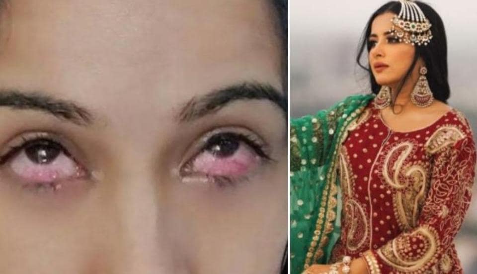 Sara Gurpal’s eye injury pics emerge online, was hurt by Nikki Tamboli during ‘edited’ Bigg Boss 14 task