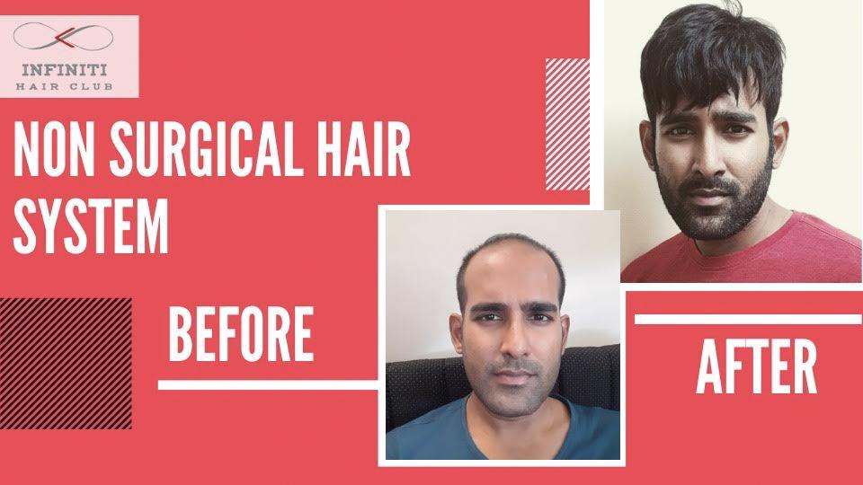 Hair Transplant In Pune 2023 Proven shot at reviving your lost hair  Hair  Transplant  Looksstudio  Blog