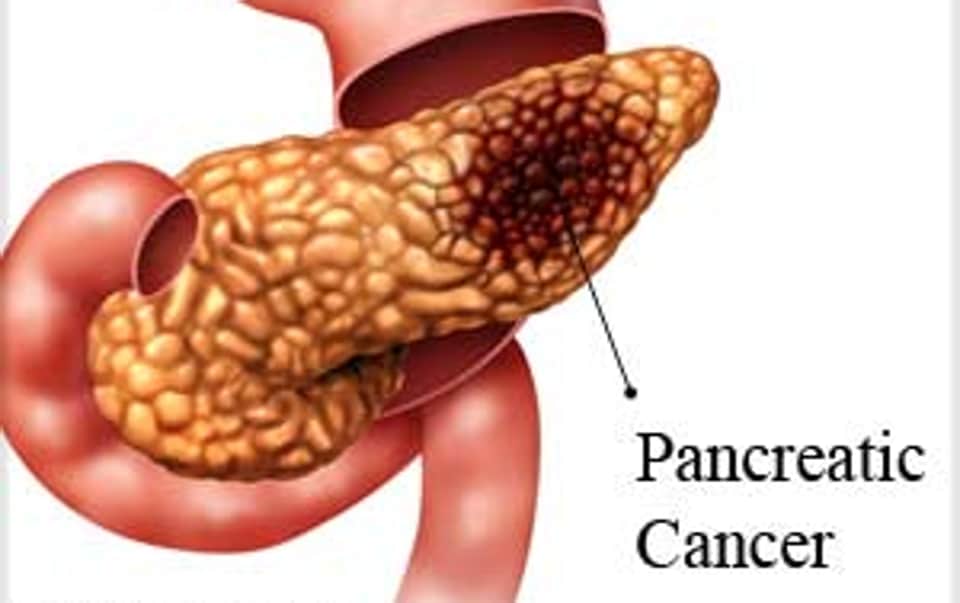 Opioid use might increase risk of developing pancreatic cancer ...