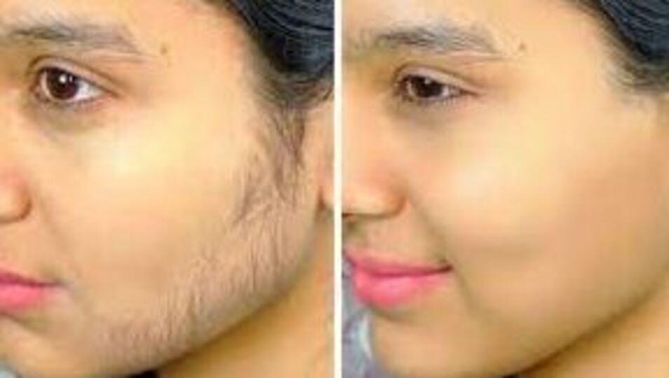 Skin Care முகத்தில் தேவையில்லாத முடியை நீக்கி பளிச்சென ஆக்குவது எப்படி