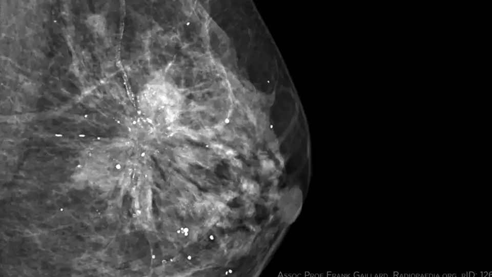 Breast Tumours: மார்பக புற்றுநோய்க்கு ஆய்வில் புதிய தீர்வு : வெளியிட்ட பிரபல இதழ்!