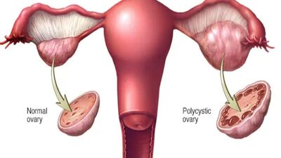 PCOS: பிசிஓஎஸ் பிரச்னையா.. இந்த உணவுகளை கண்டிப்பாக சாப்பிடுங்கள்-include  this foods to cure pcos - HT Tamil